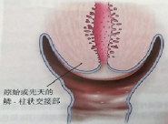 宮頸癌篩查沒那么簡(jiǎn)單，這些技巧助你提高取樣質(zhì)量